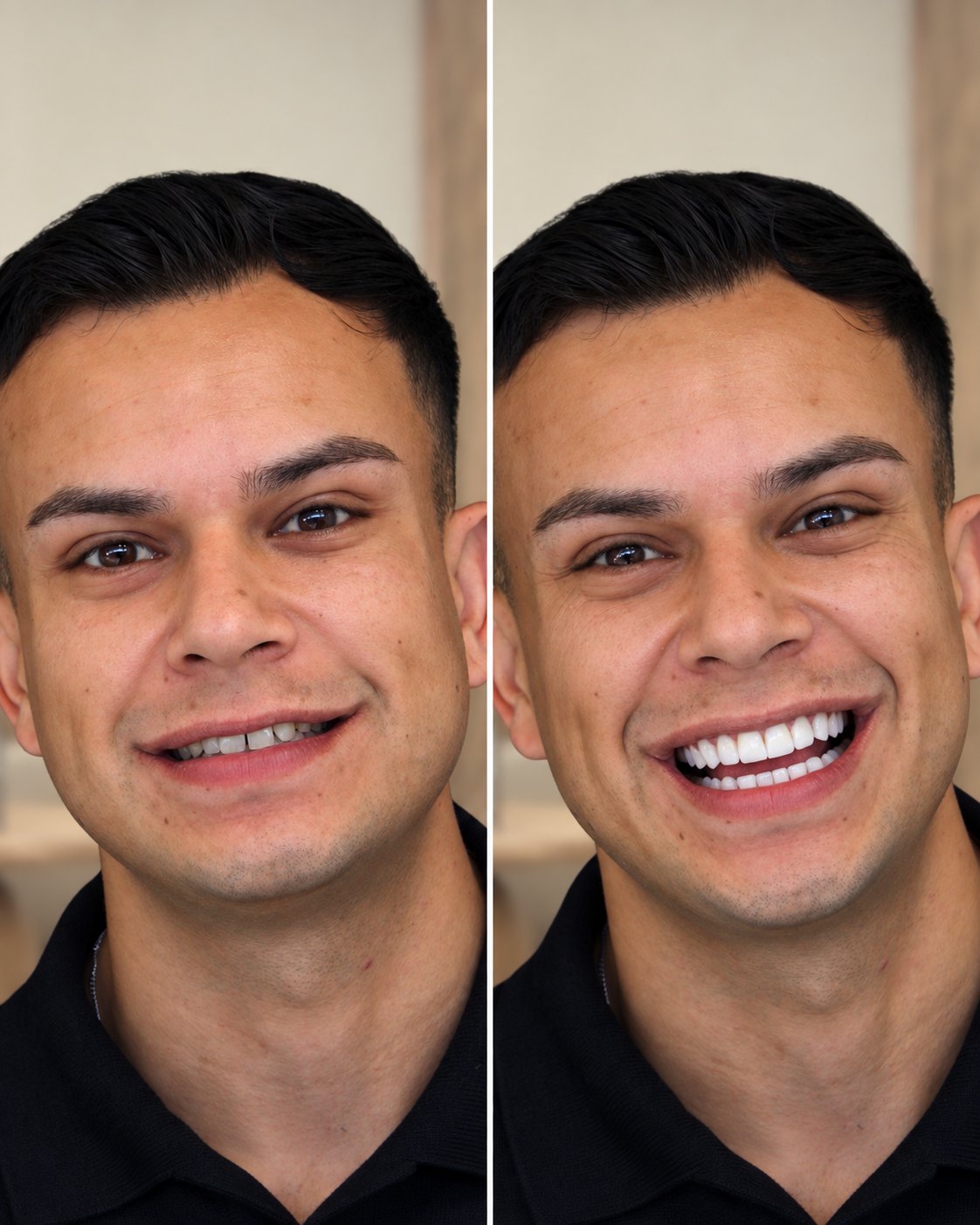 Paciente antes e depois das lentes, com sorriso mais aberto e harmônico