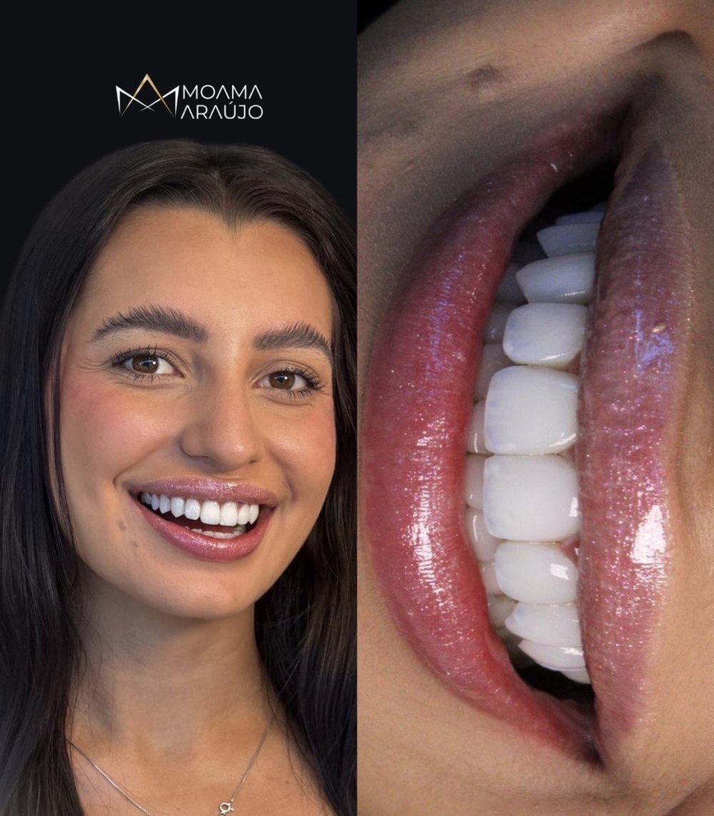 Paciente sorrindo com lentes em resina e detalhe aproximado dos dentes