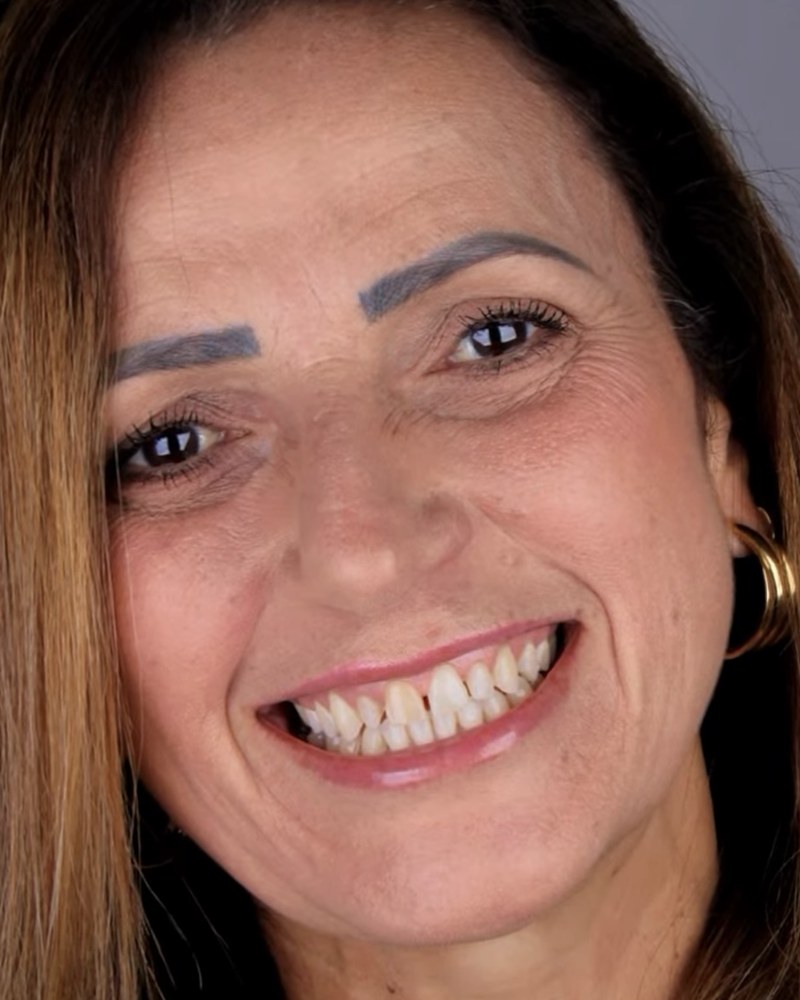 Antes: paciente com dentes desgastados, escurecidos e com espaços