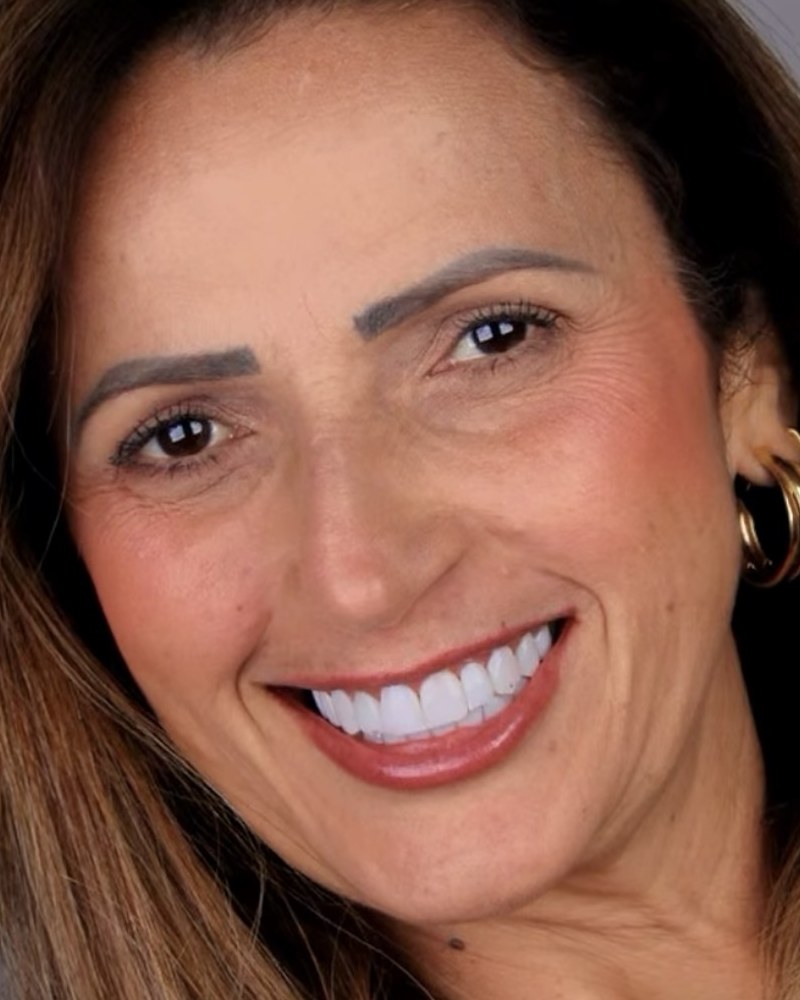 Depois: paciente com sorriso claro, alinhado e sem espaços