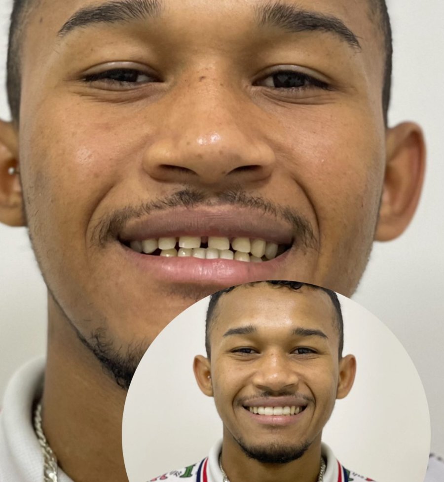 Paciente antes e depois do fechamento de espaços entre os dentes
