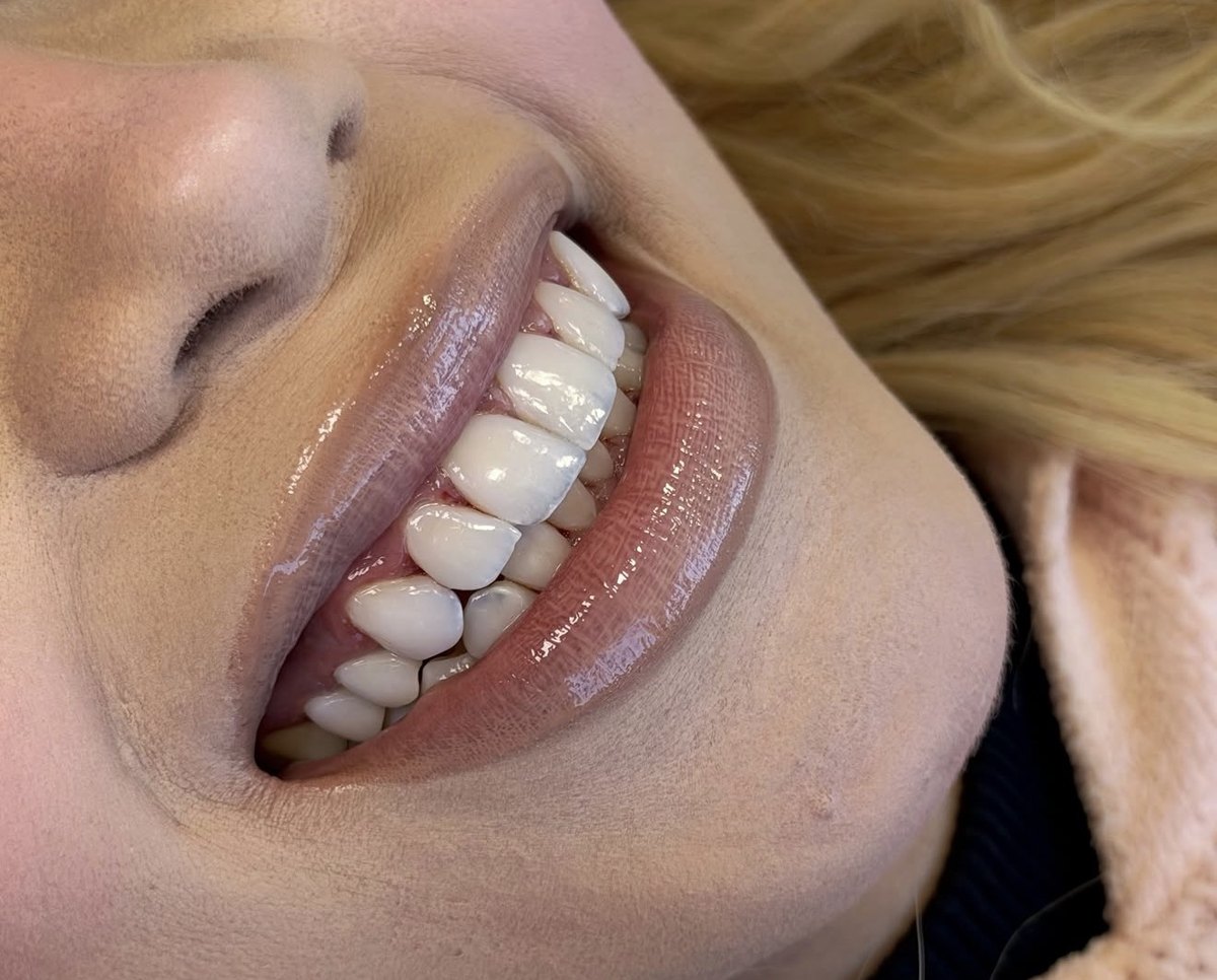 Close de sorriso com lentes em resina efeito porcelana