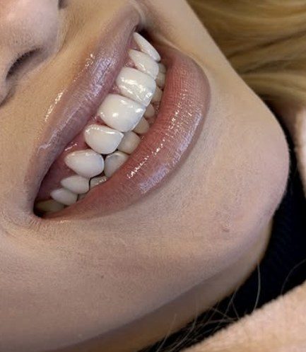 Sorriso com lentes em resina, vista lateral