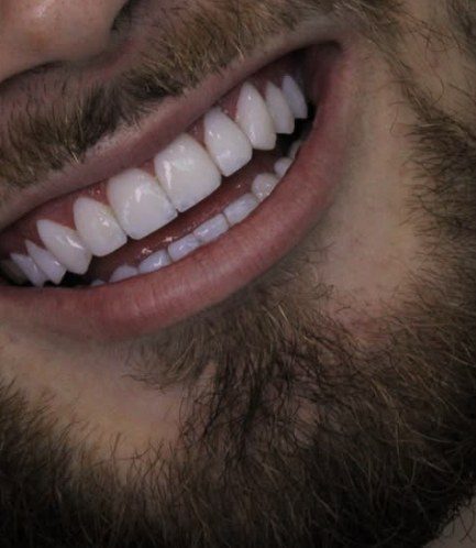 Sorriso masculino com facetas